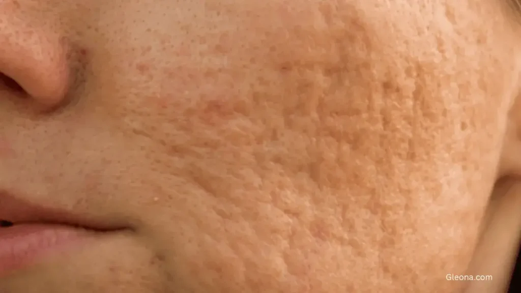 Skin Inflammation or Acne Scars