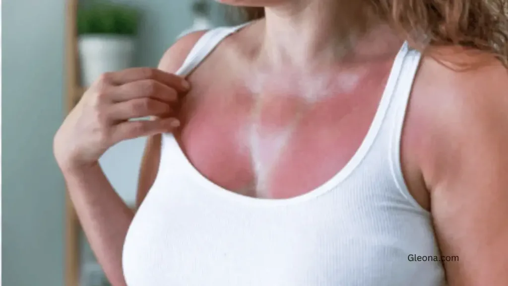 How Long Sunburn Takes to Heal (Based on Severity)