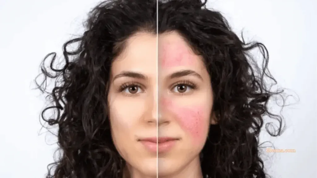 Lifestyle Changes That Help Control Rosacea