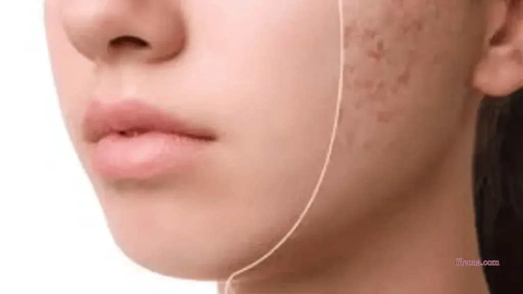 Lifestyle Tips to Prevent Acne Spots Naturally