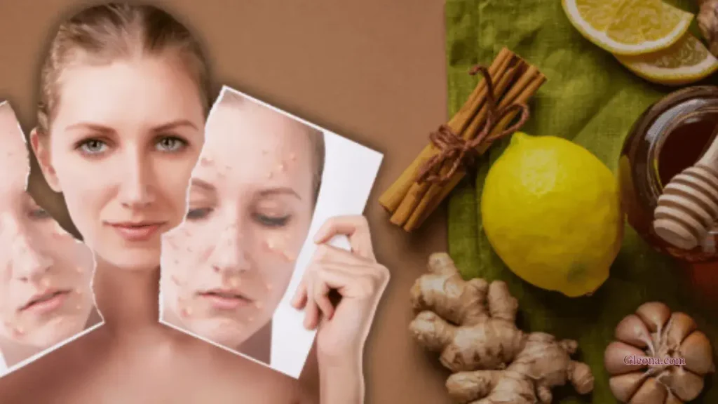 Why Choose Natural Remedies for Acne Spots